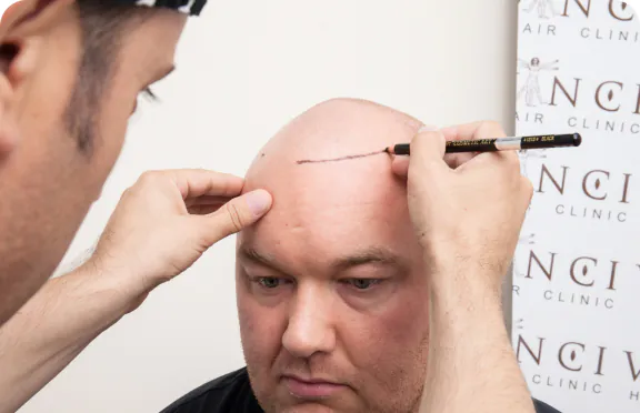 Vinci Hair Clinic specialist preparing a hair restoration treatment