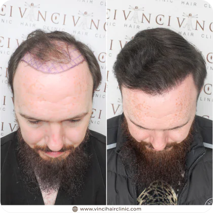 Billy Gilligan hair transplant before and after result