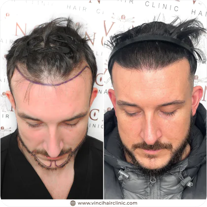 Dale Knight hair transplant before and after result