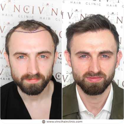 George Gedny hair transplant before and after result
