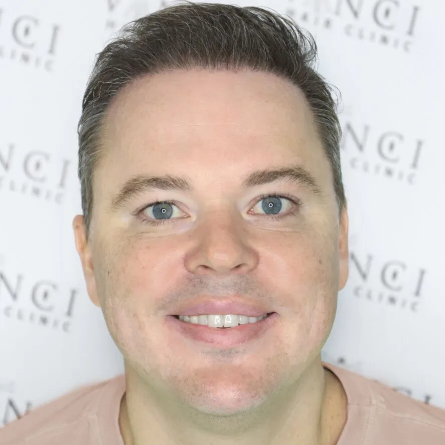 Ivan after hair restoration treatment