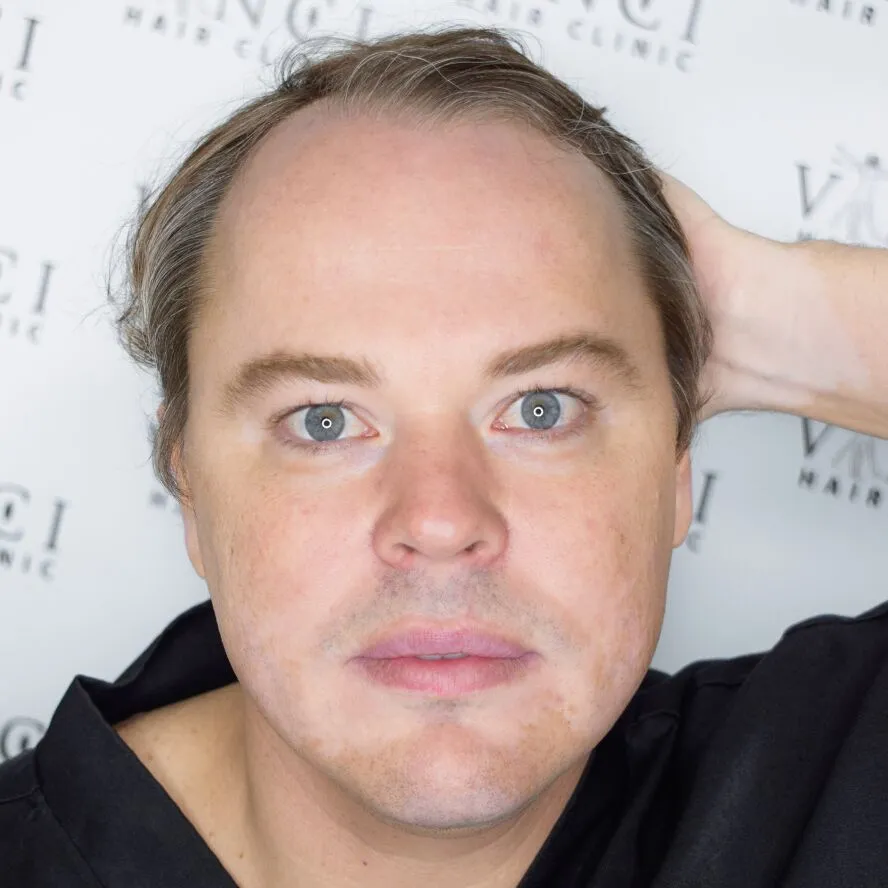 Ivan before hair restoration treatment