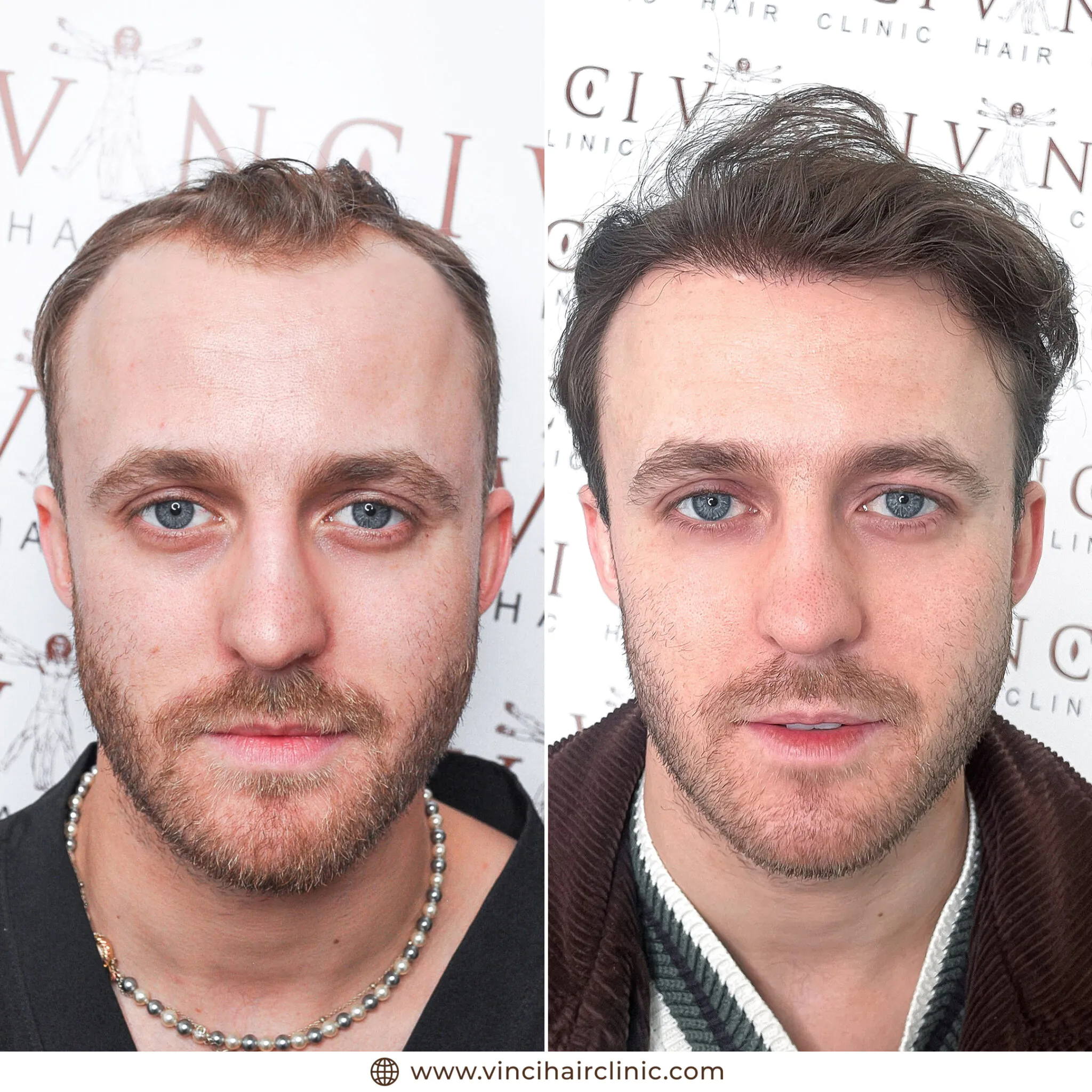 James Aveling hair transplant before and after result