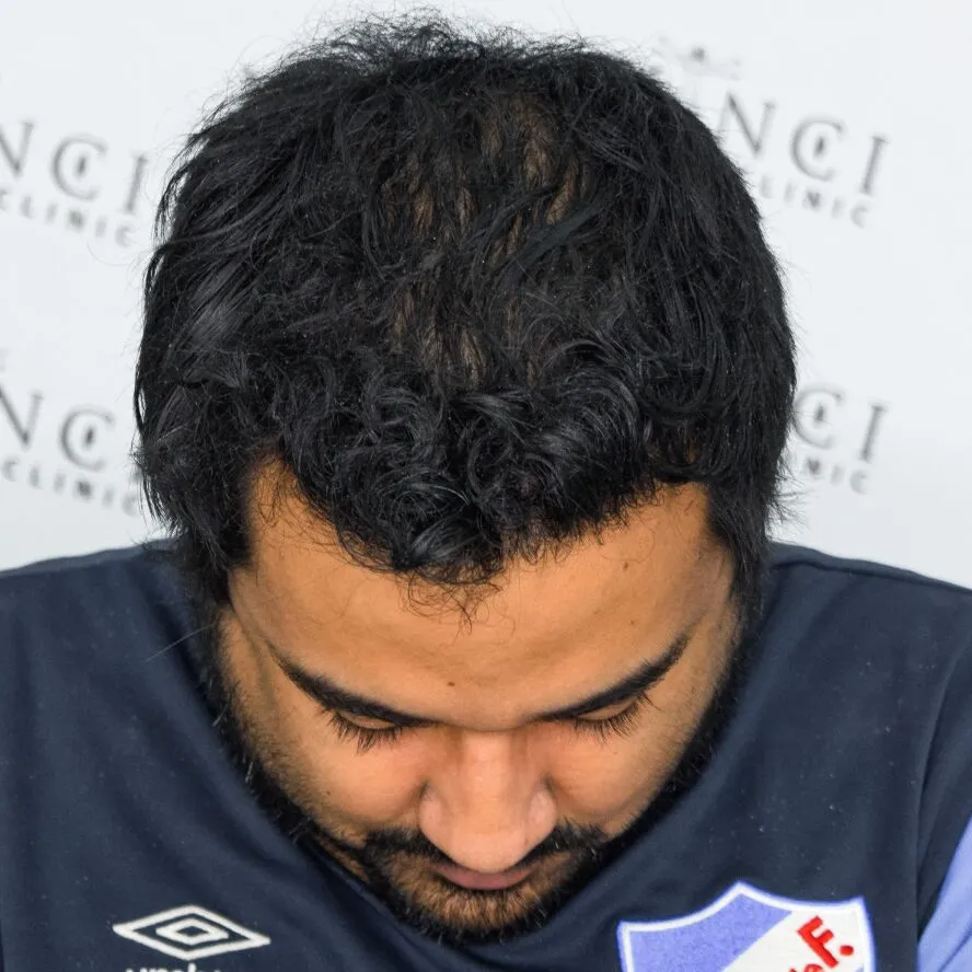 Joao Paulo after hair restoration treatment