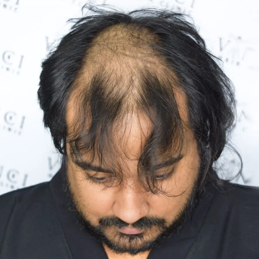 Joao Paulo before hair restoration treatment