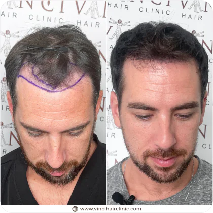 John-Paul Birss hair transplant before and after result
