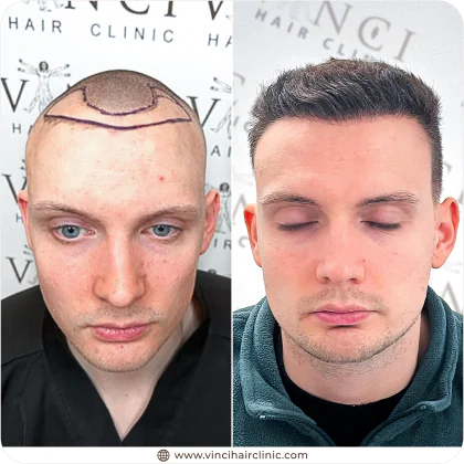 Lewis Merritt hair transplant before and after result