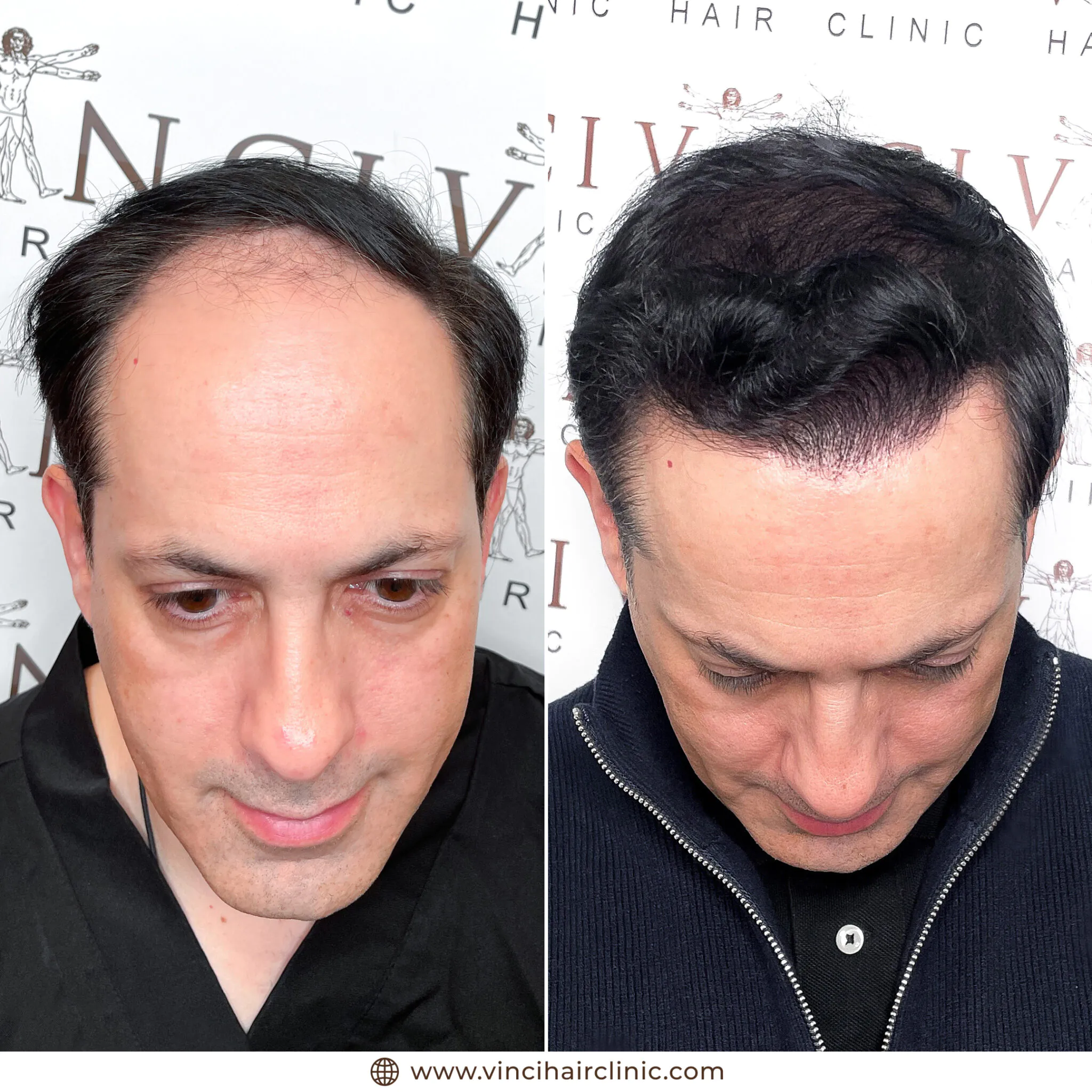 Mark Hill hair transplant before and after result