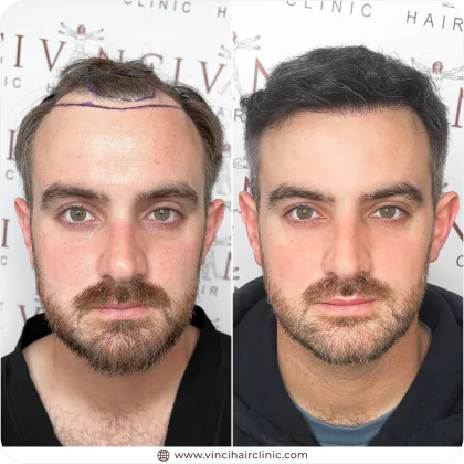 Paul Freestone hair transplant before and after result