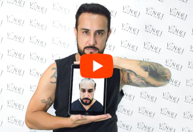 Wesley Lafaiete holding his hair restoration result photo