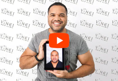 Thiago de Jesus holding his hair restoration result photo